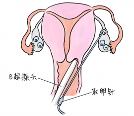 这5类女性最容易发生胎停育，大多因为这个原因!
